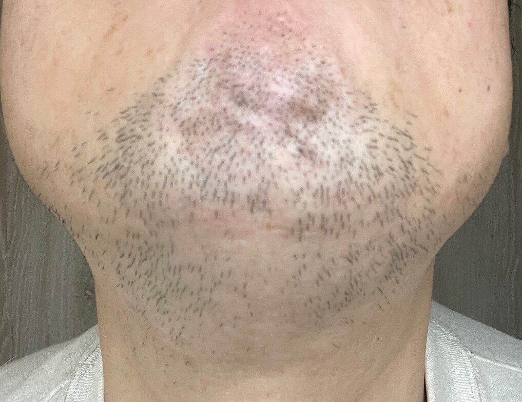 医療脱毛前のヒゲの状態|100kgパパの定点記録写真