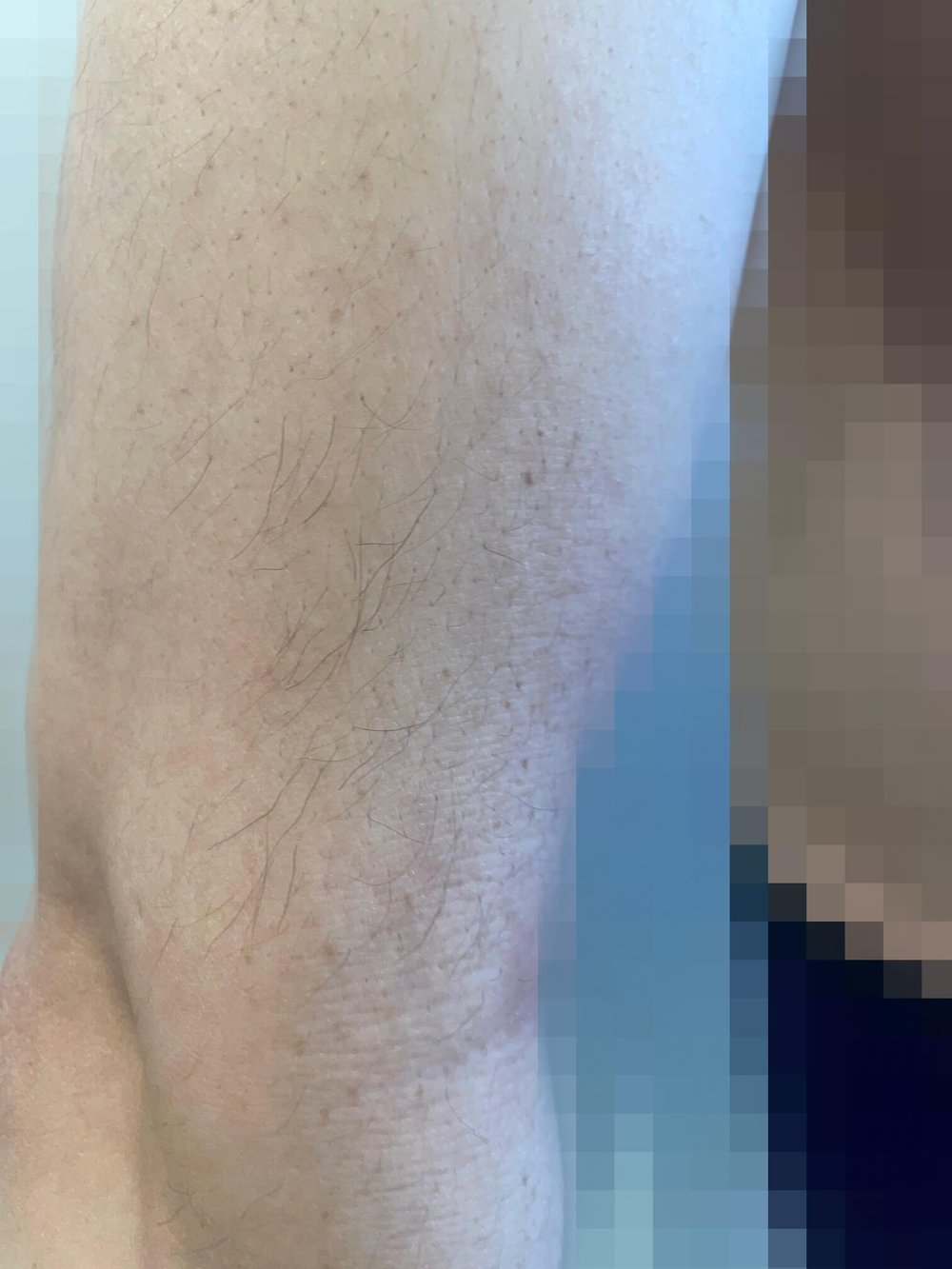 医療脱毛1回目から約2ヶ月半後の腕の毛の再生状態|100kgパパの定点記録写真