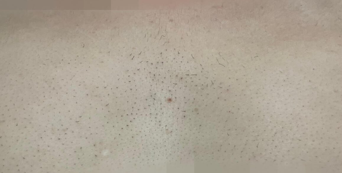 医療脱毛2回目から1週間後の胸の状態|100kgパパの定点記録写真