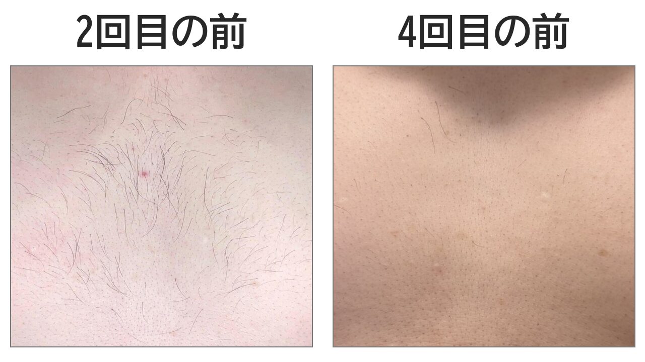 医療脱毛2回目前と4回目前の胸の毛量を比較した写真。4回目前は明らかに毛が減っている