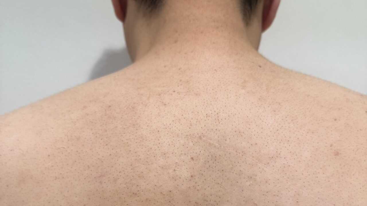 188cm100kgの男の背中。肩甲骨まわりは自分の手が届かず自己処理できない範囲|100kgパパの記録写真