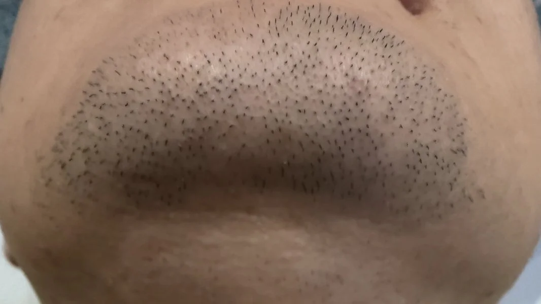 ヒゲ脱毛4回目から約1ヶ月後のアゴ。中央のヒゲはまだ残っている状態｜100kgパパの定点記録写真