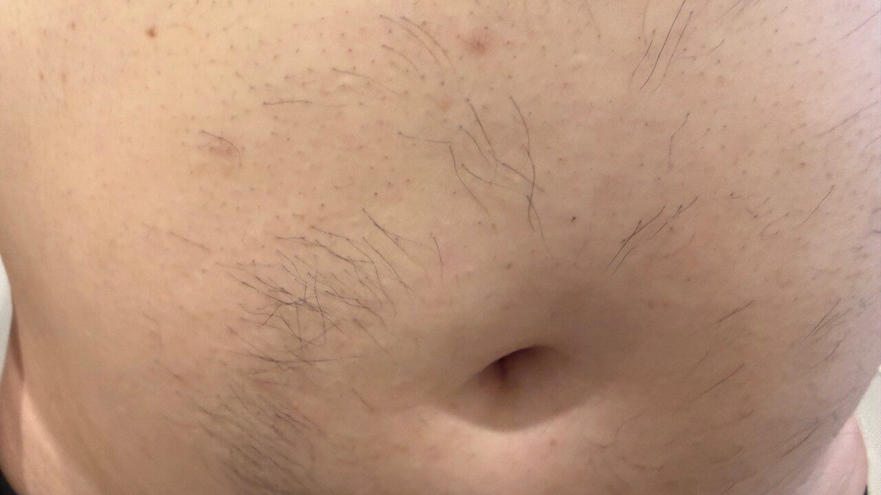 医療脱毛の照射漏れでおへそ横に一列だけ残った毛のライン|100kgパパの記録写真