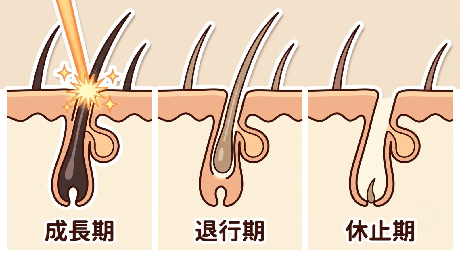 毛周期の3段階の図解。成長期は毛が濃く根が深くレーザーが反応、退行期は根が浮いて薄くなり、休止期は毛穴が空で新しい毛が待機している様子